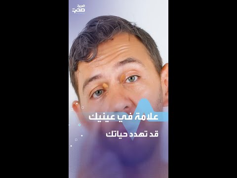 علامة في عينيك قد تهدد حياتك
