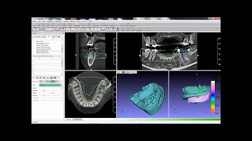GuideMia Optical scan case basic workflow part2