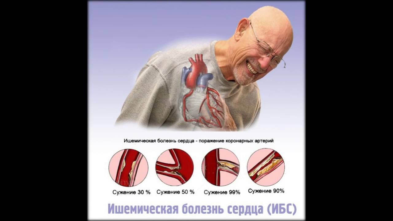 признаки ишемической болезни сердца у мужчин - YouTube