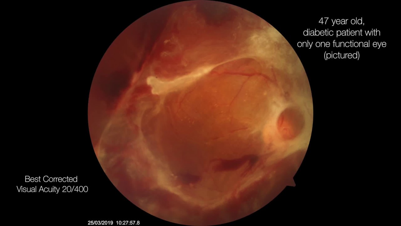 Complex Case of Proliferative Diabetic Retinopathy in a Young Patient with Only One Functional Eye