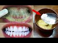 Evde 2 Dakikada DİŞ BEYAZLATMA - Sarı Dişlerinizi Doğal Olarak Nasıl Beyazlatırsınız ?