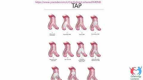 Left Main PCI   Webinar