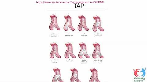 Left Main PCI   Webinar