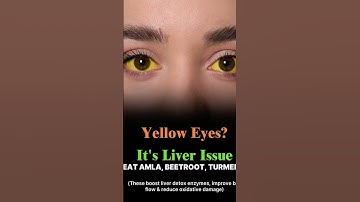 Yellow Eyes Indicator of Liver Issue #medical #medicosstuff#nurse #viral#liver #jaundice#doctor#med