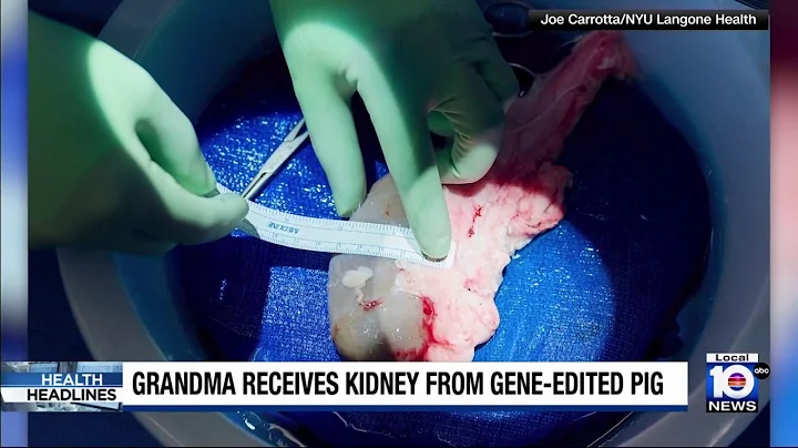 Alabama woman receives pig kidney transplant in rare procedure