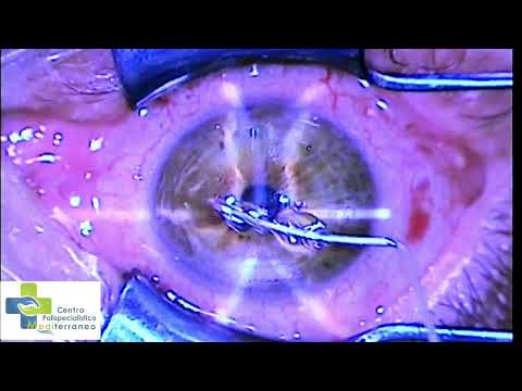 LASIK