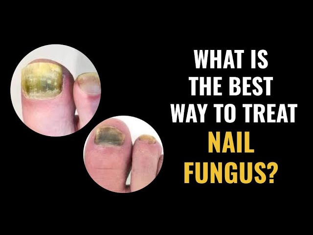 LASER FUNGAL NAIL TREATMENT | Rejuve Skin