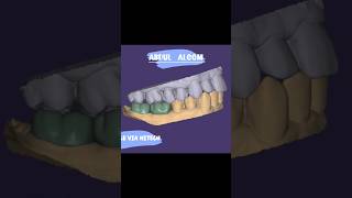 Designing 2 separate crowns in Exocad 🦷✨  #DentalDesign #CadCam #DentalLab #CrownDesign