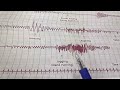 Involuntary Hyperventilation | Stethography Physiology Practical | Sagarika Basavaraj