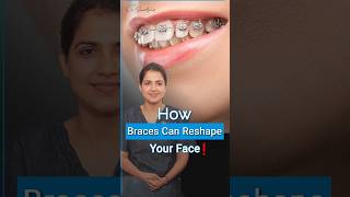 How Braces Change your Face | Braces Treatment | Orthodontist in Gurgaon |