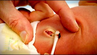 HELP! MY BABY'S BELLY BUTTON FELL OFF (and it's bleeding) | Dr. Paul