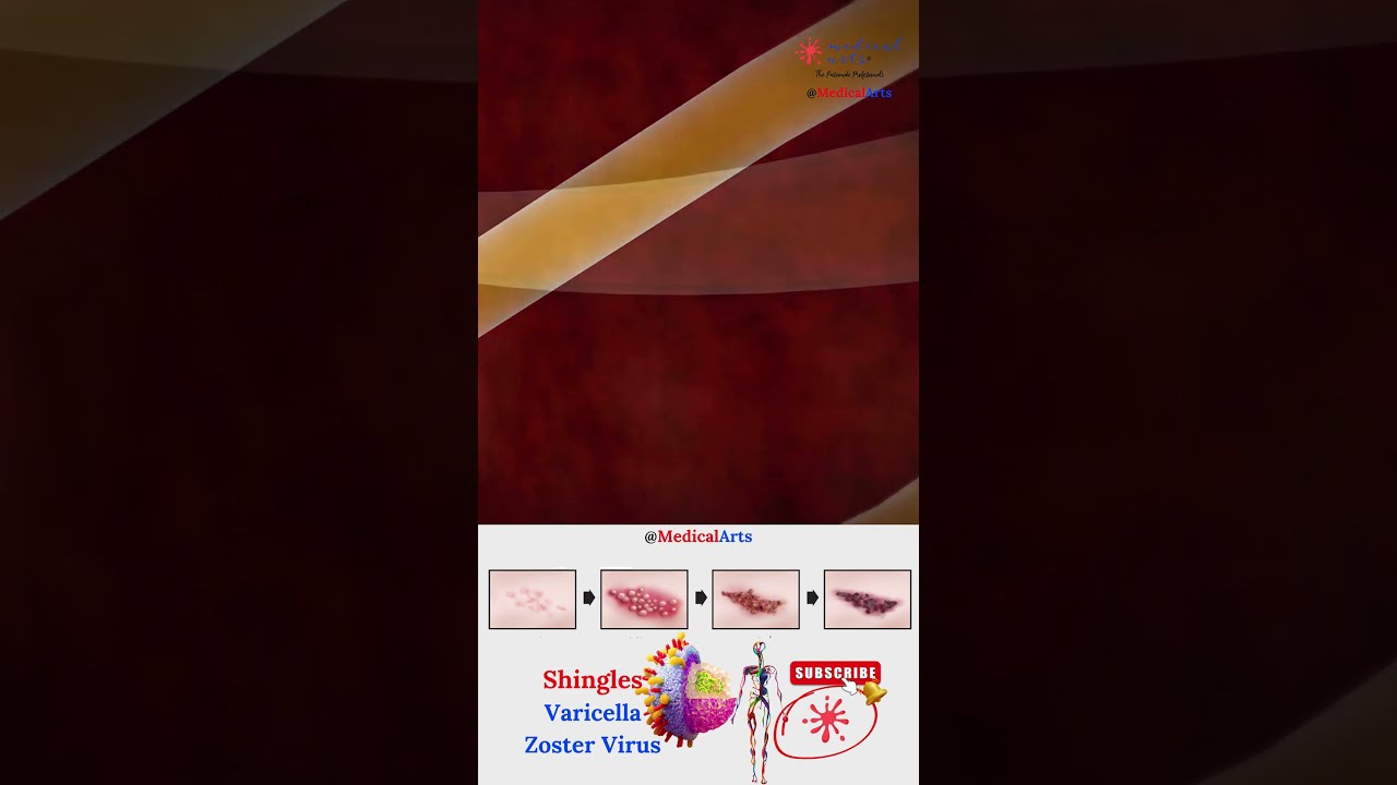Shingles Varicella Zoster Virus Herpes Shorts