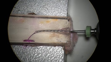 Eighteeth motor to bypass a ledge w TF and XP endo files short version