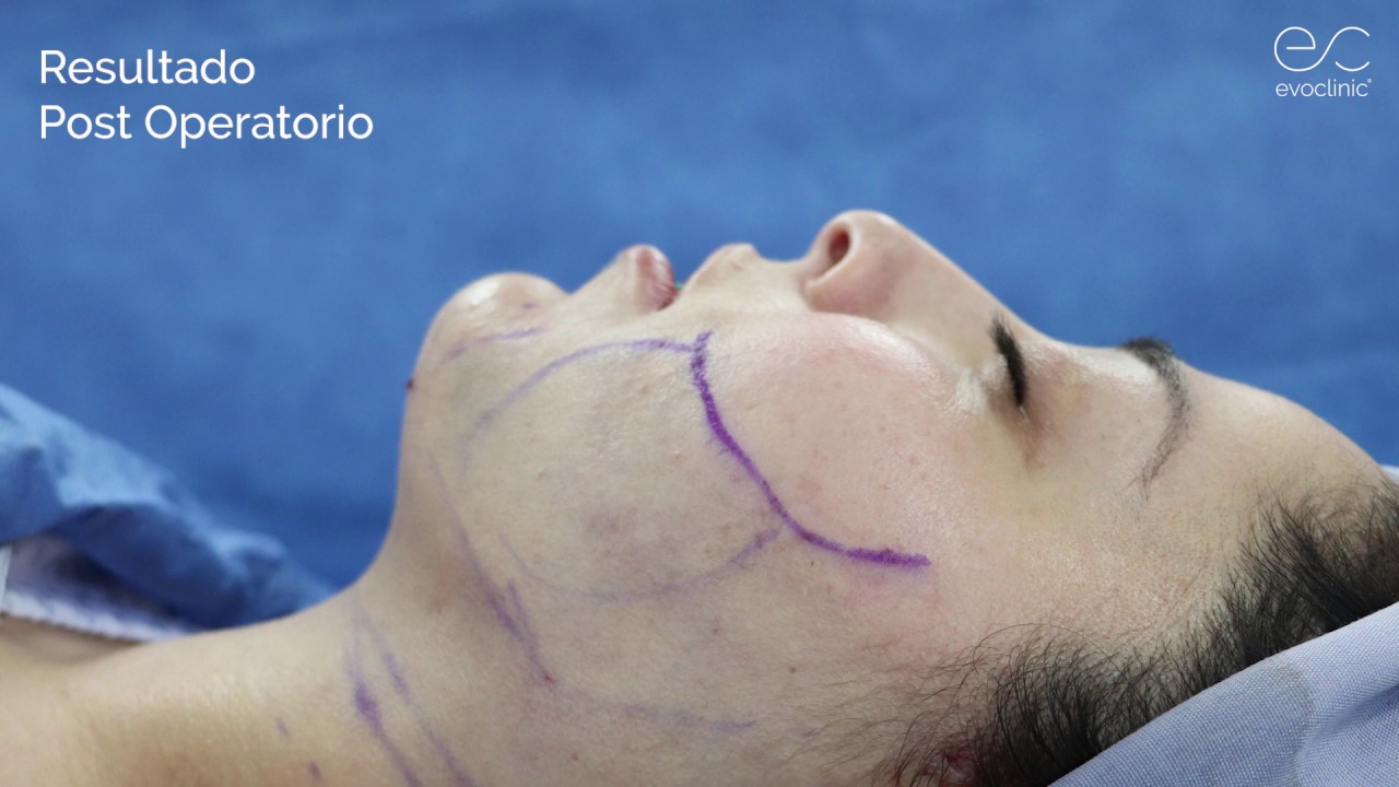 Liposucción Facial: La Guía Definitiva para un Rostro Más Definido y Joven