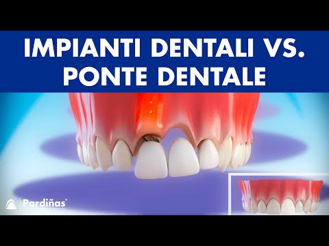 Impianti dentali vs. Ponte dentale – Confronto ©
