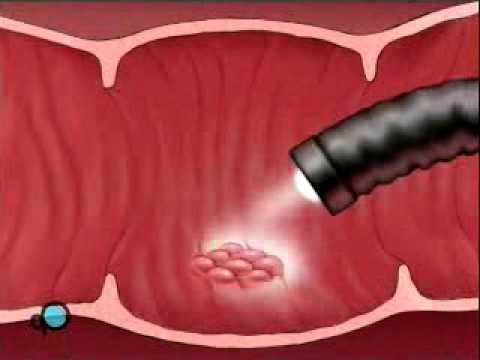 Video: Lung cancer: causes, diagnosis, treatment and prognosis by stage