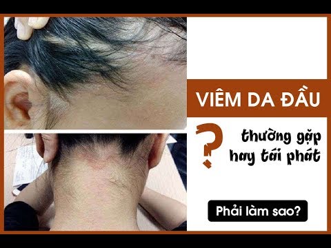 Nguyên nhân gây ngứa da đầu? Bệnh viêm da đầu là gì