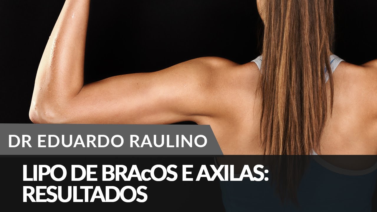 Lipo de braços e axilas: Resultados - YouTube