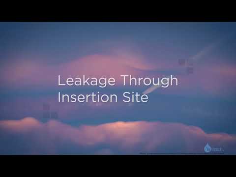 Video: Infiltration - Causes And Symptoms Of Infiltration, Diagnosis And Treatment