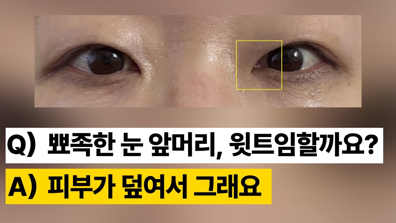 [Ганнам Соён гоо сайхны мэс заслын эмнэлэг] Гоо сайхны мэс заслын зөвлөгөө 💌 I Хурц нүдний дотор булан, дээш тэлэх мэс засал хийлгэх үү?