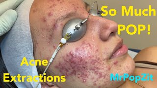 So much pop! Acne extractions on severe inflammatory acne. Multiple blackheads and whiteheads.