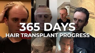 Hair Transplant 1 Year Progress