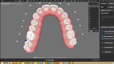 Modifying Invisalign Clincheck with 3D tools and using live update feature