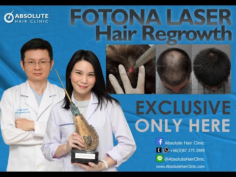 นวัตกรรมใหม่ ฟื้นฟูผมบางด้วย โฟโตน่าเลเซอร์  Fotona Laser for Hair loss Absolute Hair Clinic