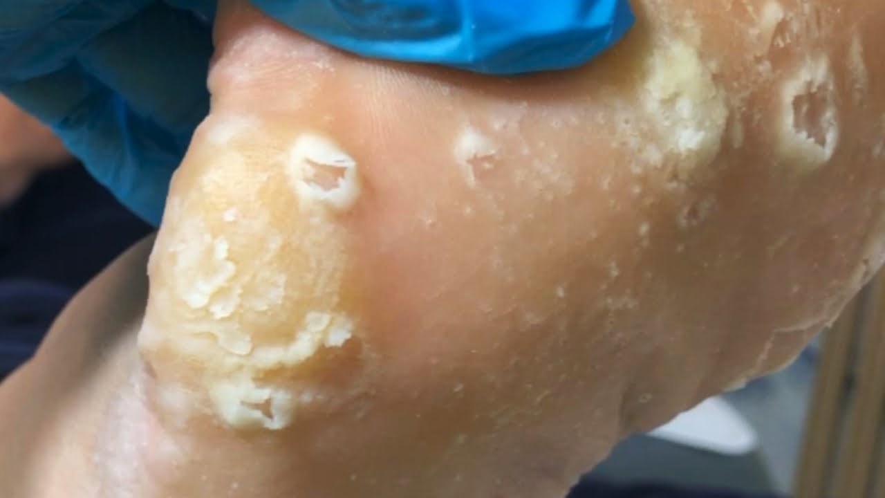 Remove Calluses From Soles Of Feet And Remove Dead Skin