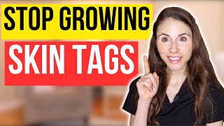 How To Stop Skin Tags From Growing | Dermatologist Tips