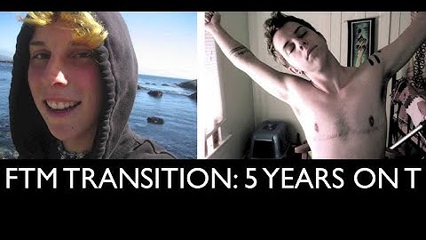 FTM Transition: 5 Years on Testosterone Picture/Timeline