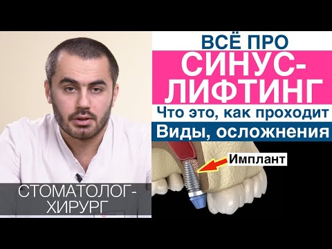 Синус-лифтинг: что это, когда необходим. Установка импланта после синус-лифтинга, закрытый, открытый