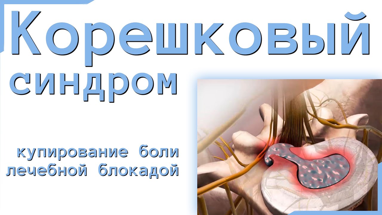 Лечебная блокада при корешковом синдроме и боли в спине