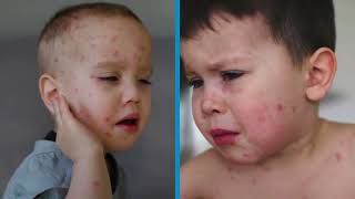 2025 Texas Measles Outbreak