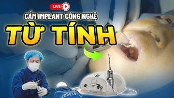 [CẬN CẢNH] Cắm Implant Bằng Công Nghệ Từ Tính: Quy Trình Trồng Răng Implant Chi Tiết Nhất