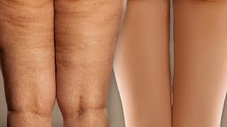 Video thumbnail of "I Used To Have Cellulite!"