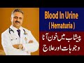 Blood in Urine ( Hematuria) , Causes &amp; Treatment.