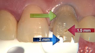 Case Of The Week Detailing The Reverse Prep Technique