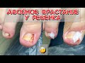 Двойное врастание у ребенка / Вросший ноготь / Педикюр / Тампонада