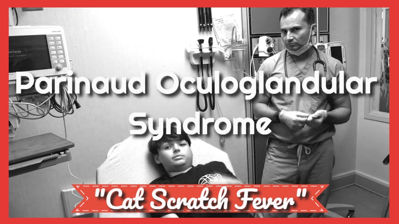 Parinaud Oculoglandular Syndrome Emergency YouTube