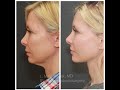 The Truth about Face and Neck Lift Incisions