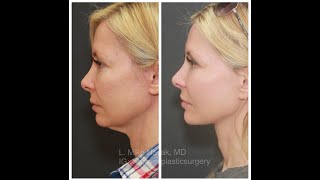 The Truth about Face and Neck Lift Incisions