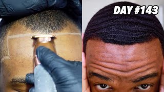 MY HAIRLINE REGROWTH JOURNEY!