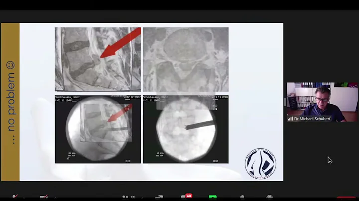Endoscopic Transforaminal Discectomy for Recurrent...