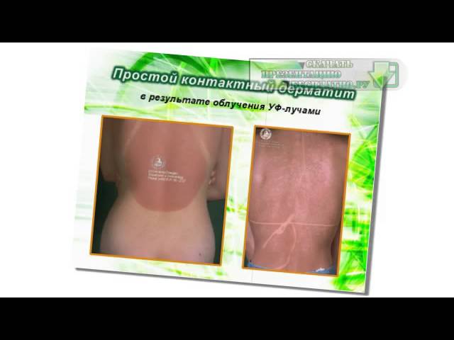 Презентация на тему Дерматиты, экземы, токсидермии