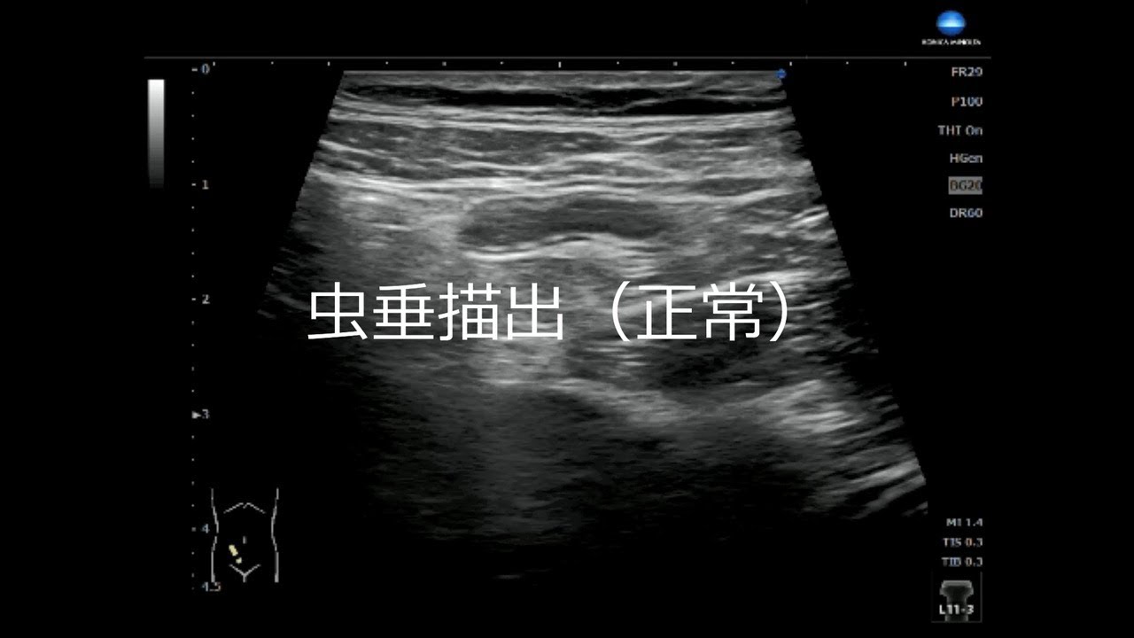 腹部エコー虫垂描出（正常）_隠岐島前病院 白石吉彦 先生作成【コニカ
