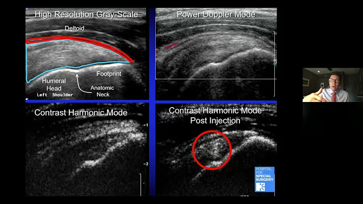 Shoulder Replacement in 2021 - J.R. Rudzki, M.D., ...
