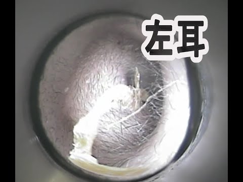 Vol.285【耳掃除】ながーーーーい耳垢！！　eariss