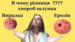 Виразка шлунка і двандятипалої кишки та ерозивний гастрит і бульбіт - це те саме? І в чому різниця?