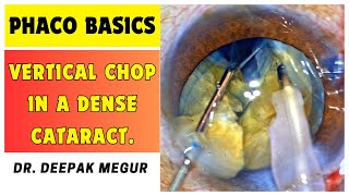 Phaco Basics - Vertical Chop In A Dense Cataract - Dr Deepak Megur
